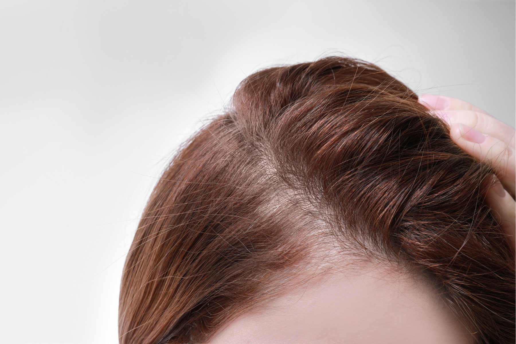 The Stages of Female Patterned Baldness