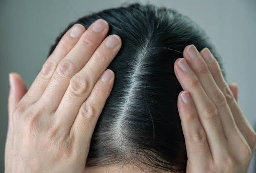 Woman parting hair with hands to show scalp.